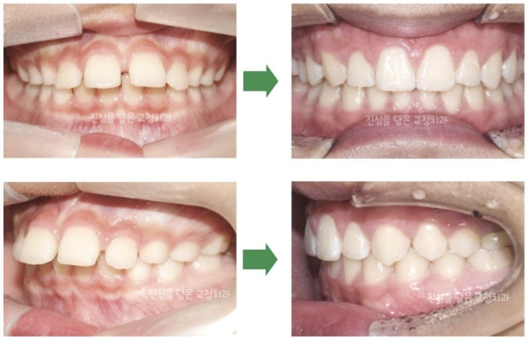 성장조절 및 비발치교정을 통해 개선한 앵글씨 2급 부정교합 어린이 환자 사례